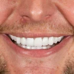 هوليود سمايل في تركيا مع روز ميديكال