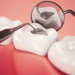 Dental Fillings: Types, Lifespan & When to Replace Them