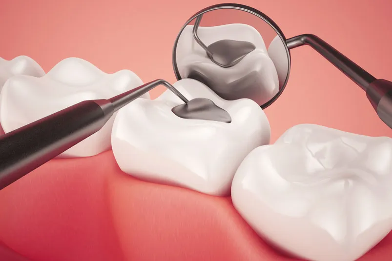 Dental Fillings: Types, Lifespan & When to Replace Them