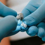 Zirconia crowns durability explained