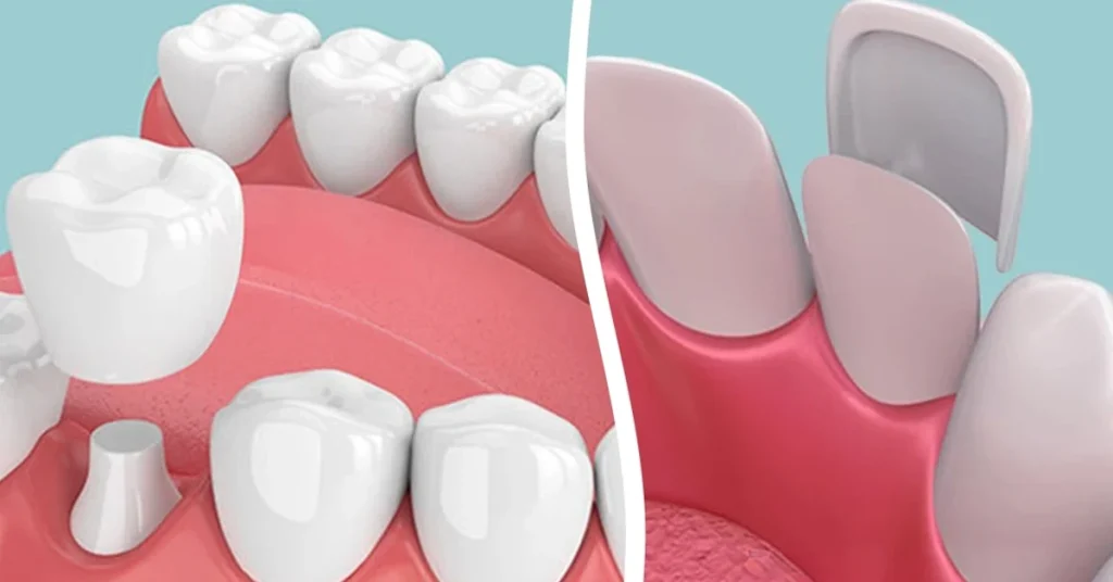 Facettes vs crowns: which is right for you?