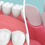 Facettes vs crowns: which is right for you?
