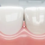 Zirconia vs porcelain crowns_ which is better